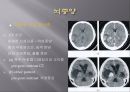 Brain CT에 관한 PPT 23페이지