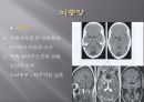 Brain CT에 관한 PPT 29페이지