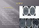 Brain CT에 관한 PPT 30페이지