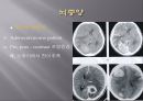 Brain CT에 관한 PPT 31페이지