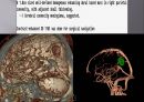 Brain CT에 관한 PPT 47페이지