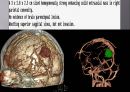 Brain CT에 관한 PPT 52페이지