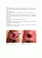 치질 Hemorrhoid - 치질 케이스 스터디, 치질 case study, 치질 간호과정, 치질 간호진단, Hemorrhoid case, Hemorrhoid 사례연구 9페이지