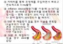 PTCA (경피적 관상동맥 성형술) 8페이지