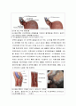 식도정맥류(esophageal varix) 간호 10페이지