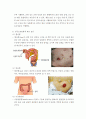 장루간호(수술전,수술후,종류) 9페이지