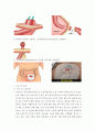 장루간호(수술전,수술후,종류) 11페이지