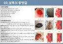 장루의 유형, 장루간호 합병증,장루간호절차성인간호실습주제발표 11페이지