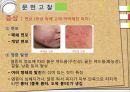 아동간호학 간호과정 여드름 PPT 4페이지