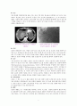 간암liver cancer case 2페이지