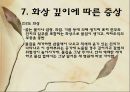 화상 (BURNS) - 화상의 발생빈도 원인 위험요인 진단 종류 20페이지