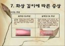 화상 (BURNS) - 화상의 발생빈도 원인 위험요인 진단 종류 21페이지