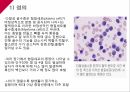 A+다발성 골수종Case conference 4페이지