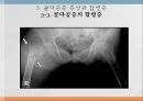 노인의 골다공증골다공증 현황과 문제점골다공증 정의골다공증 원인 요인 및 분류골다공증 증상과 합병증골다공증 진단골다공증 예방과 관리골다공증을 위한 대책 21페이지
