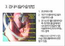 a+++ 수술간호 ppt 편도절제술 1. 편도란? 2. 적응증 3. 검사/시술/수술 방법 4. 준비사항 5. 경과 및 합병증 6. 수술 전 간호 7. 수술 후 간호 8. 참고문헌 9. 느낀점 5페이지