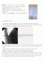 Kyphoplasty(경피적 풍선 척추 성형술) 8페이지