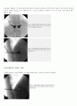 Kyphoplasty(경피적 풍선 척추 성형술) 9페이지