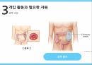 대장암 환자,암 의학적,대장의 역할,대장암의 원인,대장암의 진행,대장암의 진단,대장암의 치료 46페이지