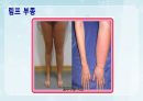 성인간호학(비뇨생식기계질환,은하출판사) 84페이지