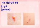 성인간호학(피부계질환,은하출판사) 16페이지