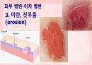 성인간호학(피부계질환,은하출판사) 19페이지