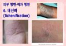 성인간호학(피부계질환,은하출판사) 22페이지