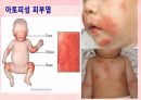 성인간호학(피부계질환,은하출판사) 36페이지