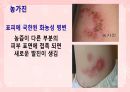 성인간호학(피부계질환,은하출판사) 40페이지