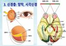 성인간호학(안과질환,은하출판사) 9페이지