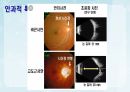 성인간호학(안과질환,은하출판사) 16페이지