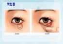 성인간호학(안과질환,은하출판사) 17페이지