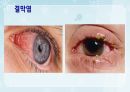성인간호학(안과질환,은하출판사) 22페이지