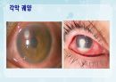 성인간호학(안과질환,은하출판사) 23페이지