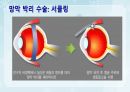 성인간호학(안과질환,은하출판사) 29페이지