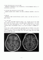 Moyamoya, Cerebral infarction (모야모야병, 뇌경색) 11페이지