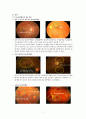 성인간호학_Case study_Vitreous hemorrhage 7페이지