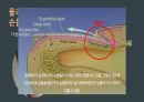 응급간호(손톱, 발톱 빠짐) 발표자료 15페이지