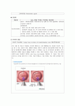 cervical dysplasia(자궁경부이형성증) 케이스 11페이지