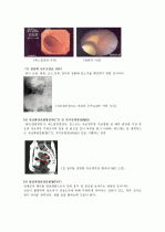 cervical dysplasia(자궁경부이형성증) 케이스 21페이지