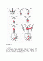 cervical dysplasia(자궁경부이형성증) 케이스 23페이지