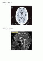 [2016/09]뇌수막염 case(뇌수막염의 정의, 뇌수막염의 원인, 뇌수막염의 증상, 뇌수막염의 진단검사 방법, 뇌수막염의 예방 방법, 뇌수막염 환자의 CASE)  6페이지