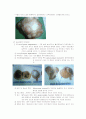 자궁근종 (Uterine Myoma)병태생리 3페이지