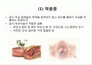TVH (질식자궁절제술 :Total vaginal hysterectomy) 13페이지