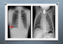 위장관계 환자의 사정과 간호 (위장계, 게실질환, 맥켈게실, appendicitis, PUD, 위궤양, 십이지장궤양, 급성 복막염, 위장관 출혈, 탈장, 크론병 & 궤양성 대장염, 위장관 출혈 case study).pptx
 27페이지