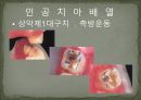 세미나자료 구강해부학의 총의치(덴쳐) 제작(치의학, 치기공, 치위생) 70페이지